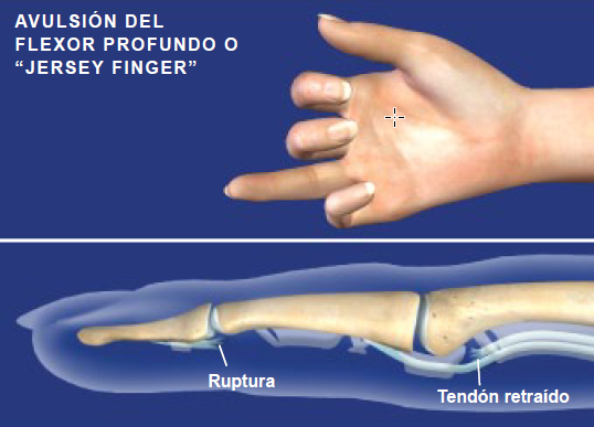 tendones flexores de la muñeca